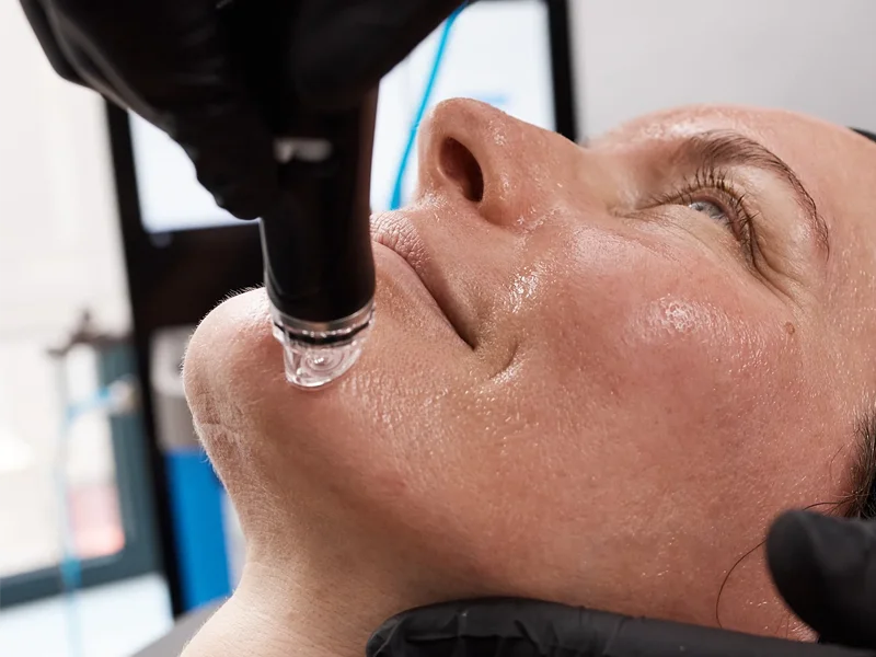 Deep skin exfoliation on chin using Hydrafacial tip.