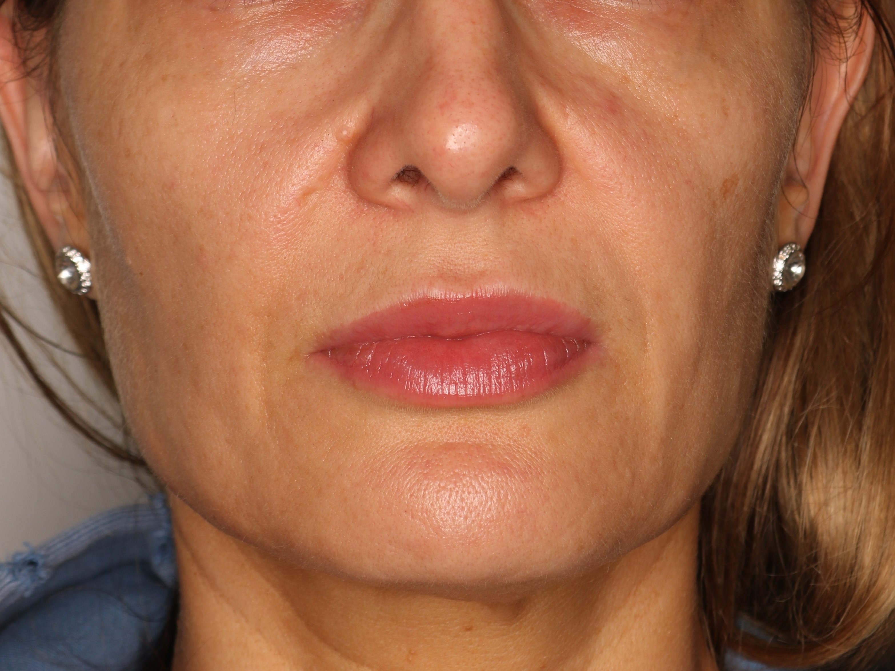 Efekt zabiegu kwas hialuronowy - Po 3