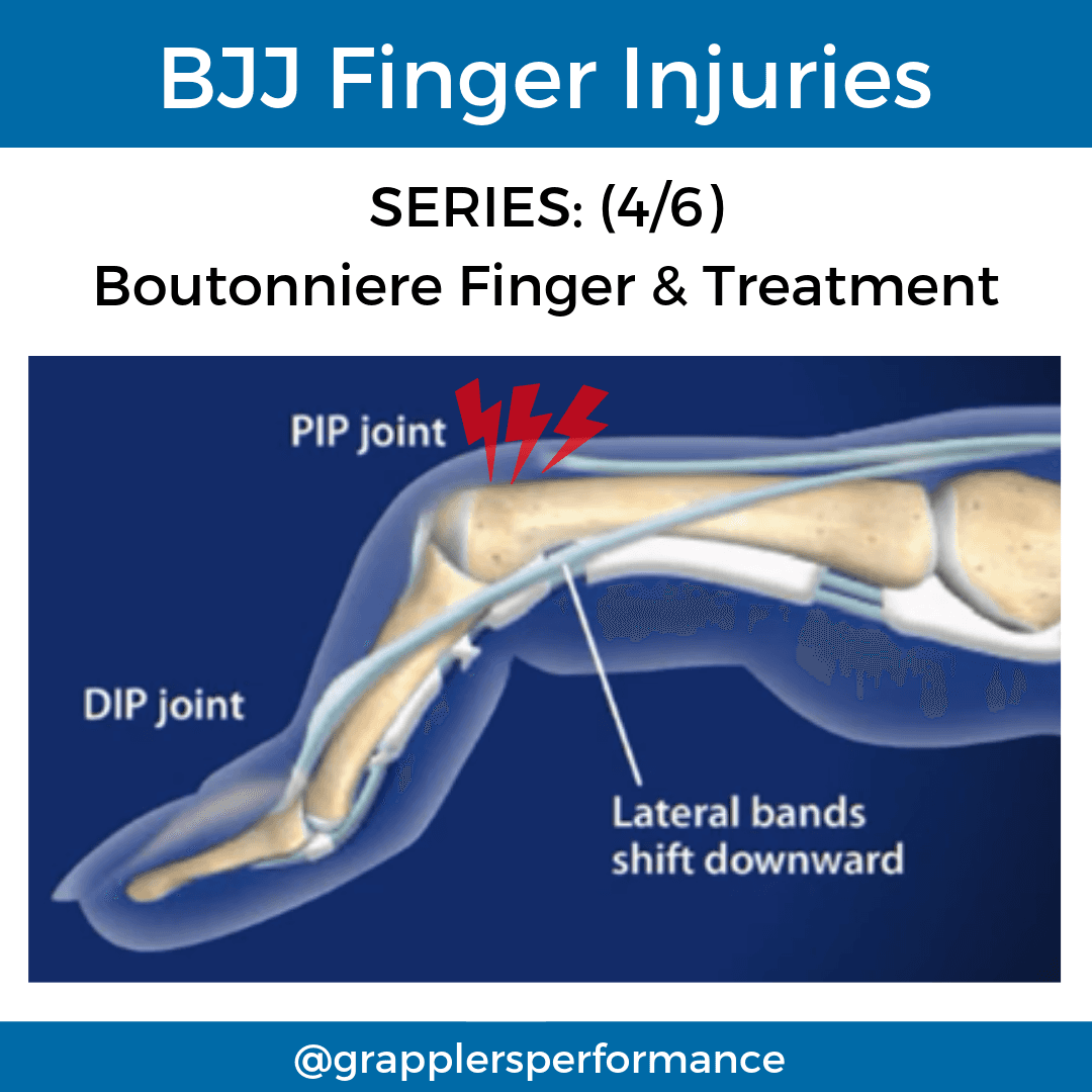 Diagram of boutonniere deformity showing torn central slip at the proximal interphalangeal (PIP) joint. The finger is bent at the PIP while the distal joint is hyperextended.