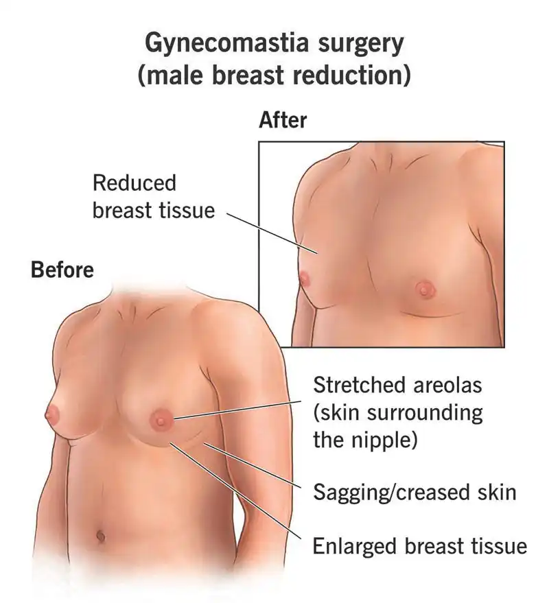 Gynecomastia before and after surgery results showing chest contour improvement