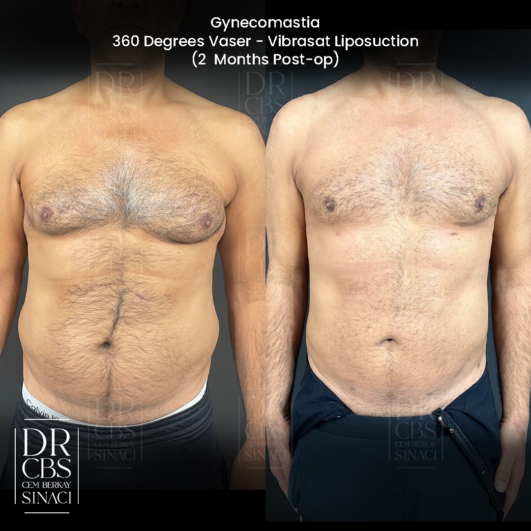 gynecomastia correction vaser liposuction and laser skin tightening for abdomen before after front view