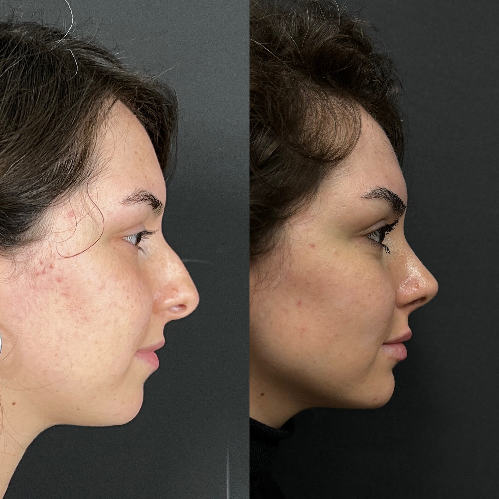 8 months post-op rhinoplasty before after side view