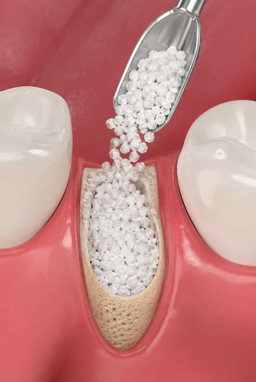 Medical illustration showing bone grafting material being placed into the jaw to support future dental implant treatment.