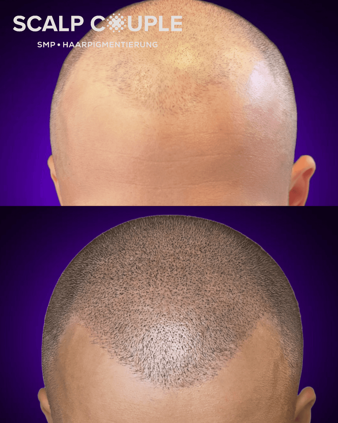 Haarpigmentierung Mann Vorher Nachher – SMP Ergebnis | Scalp Couple