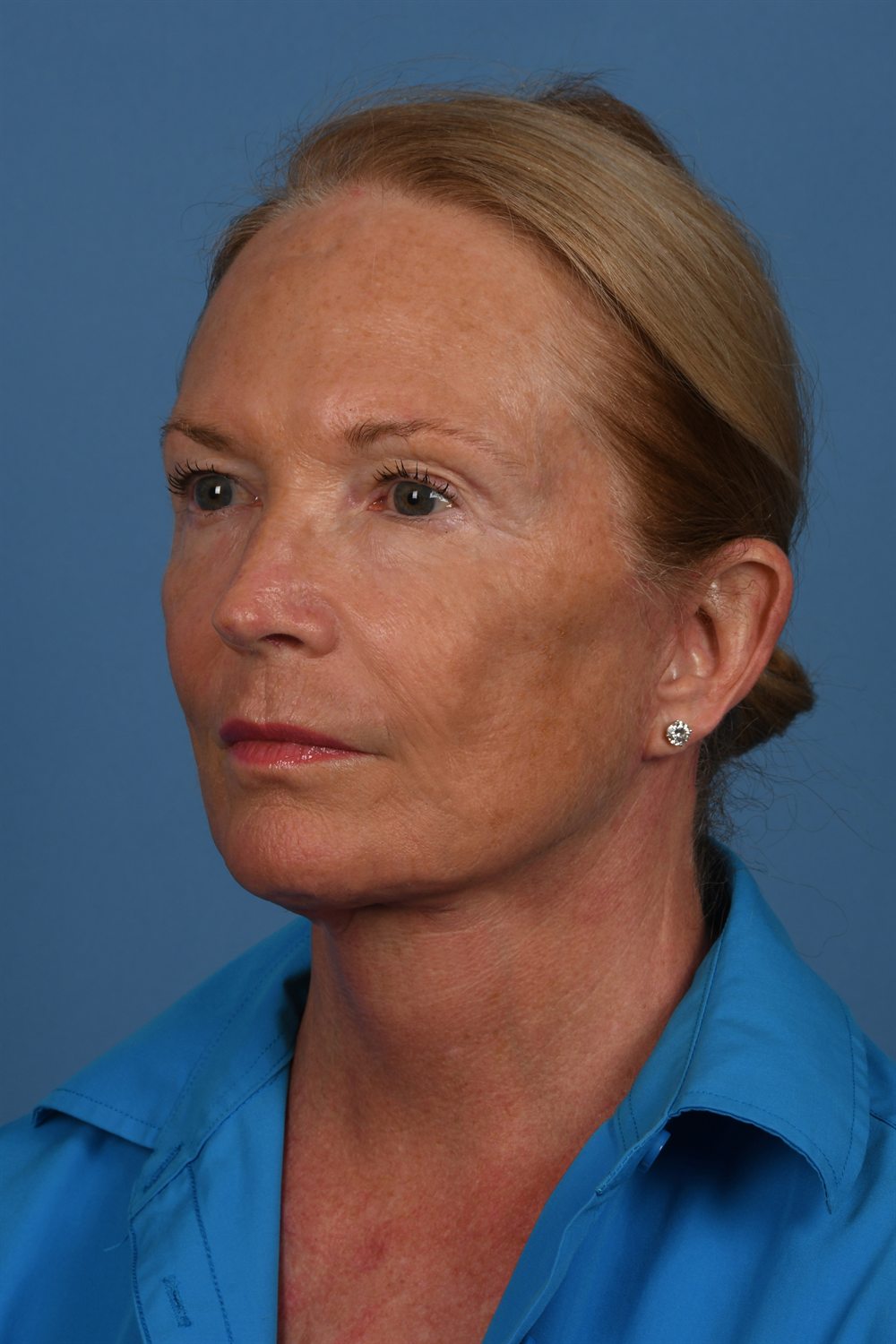 Facelift patient after surgery, three-quarter view, left side