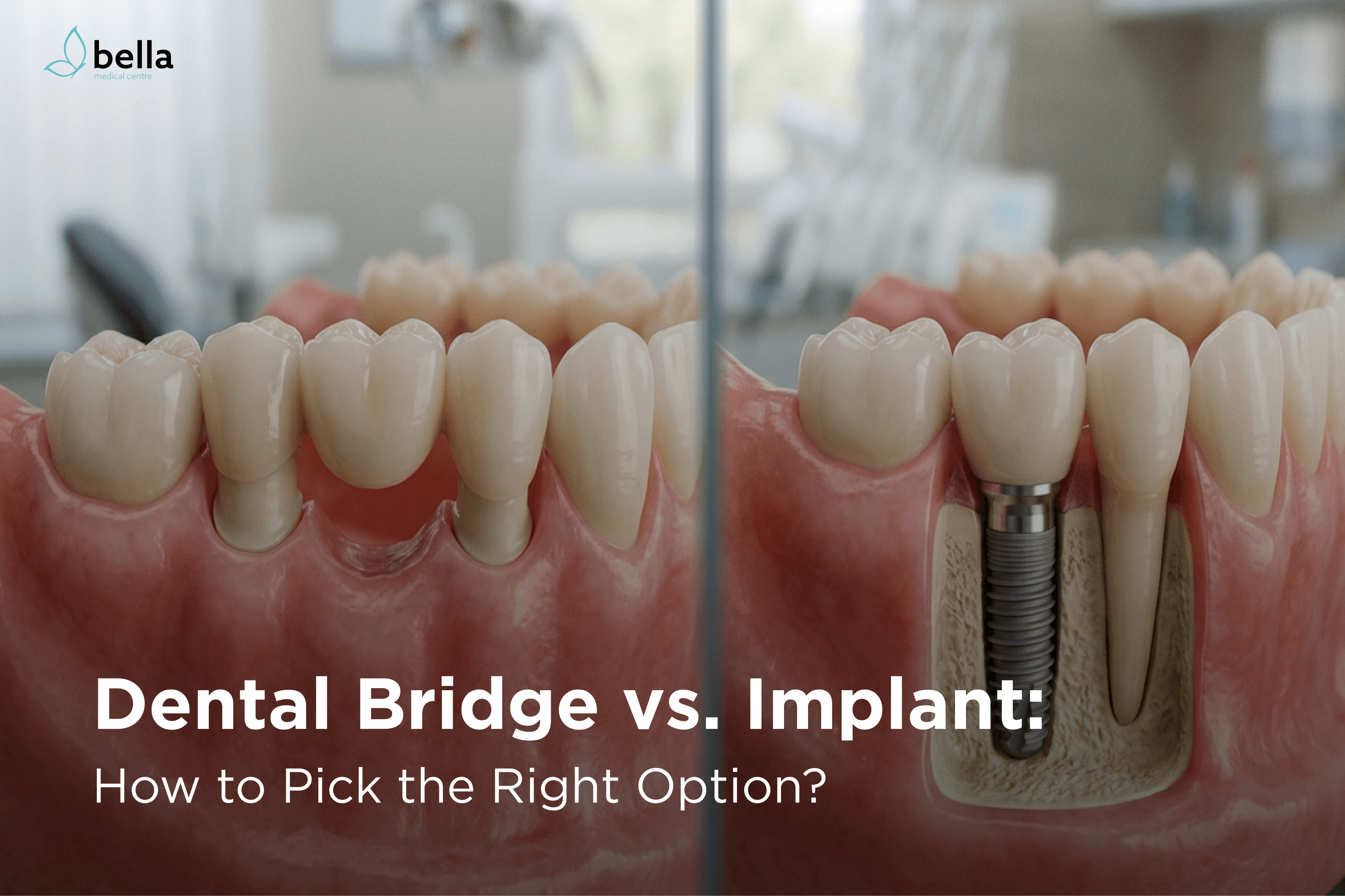 Dental Bridge vs. Implant: Which Is Right for You?