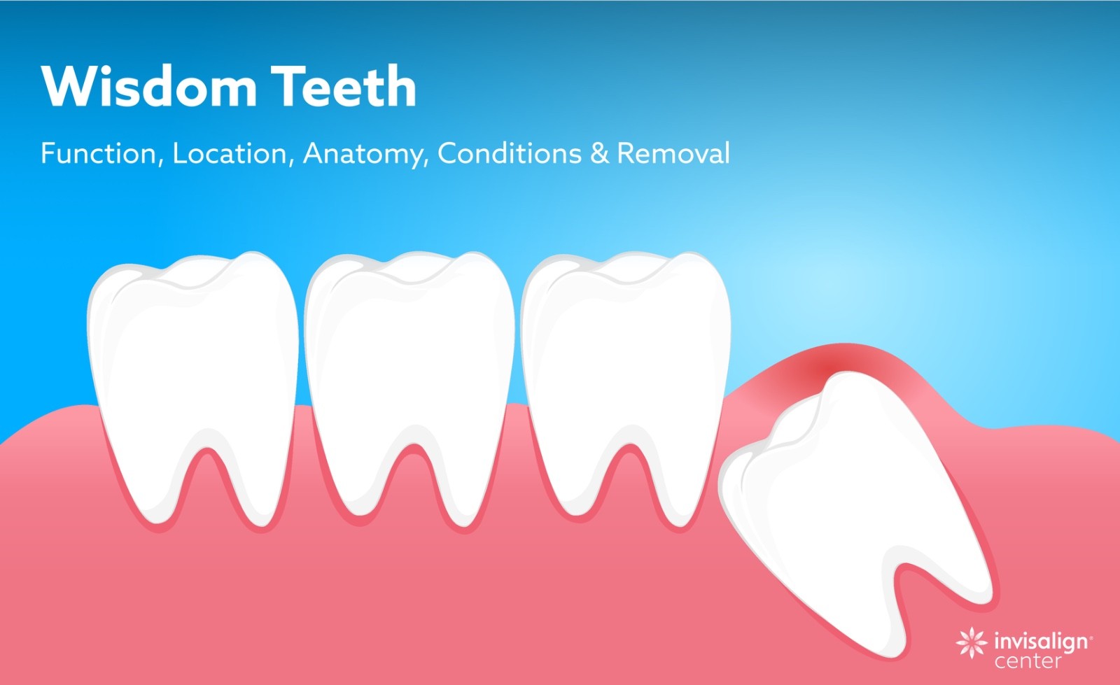 Wisdom Teeth: Function, Location, Anatomy, Conditions & Removal 