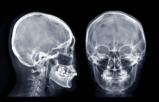 Lateral and frontal x-rays (cephalometric analysis)