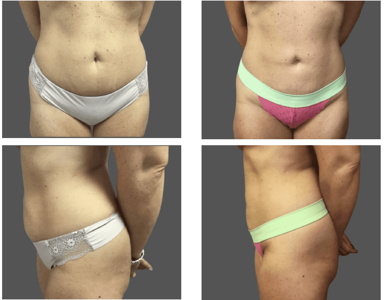Before and after of surgery image