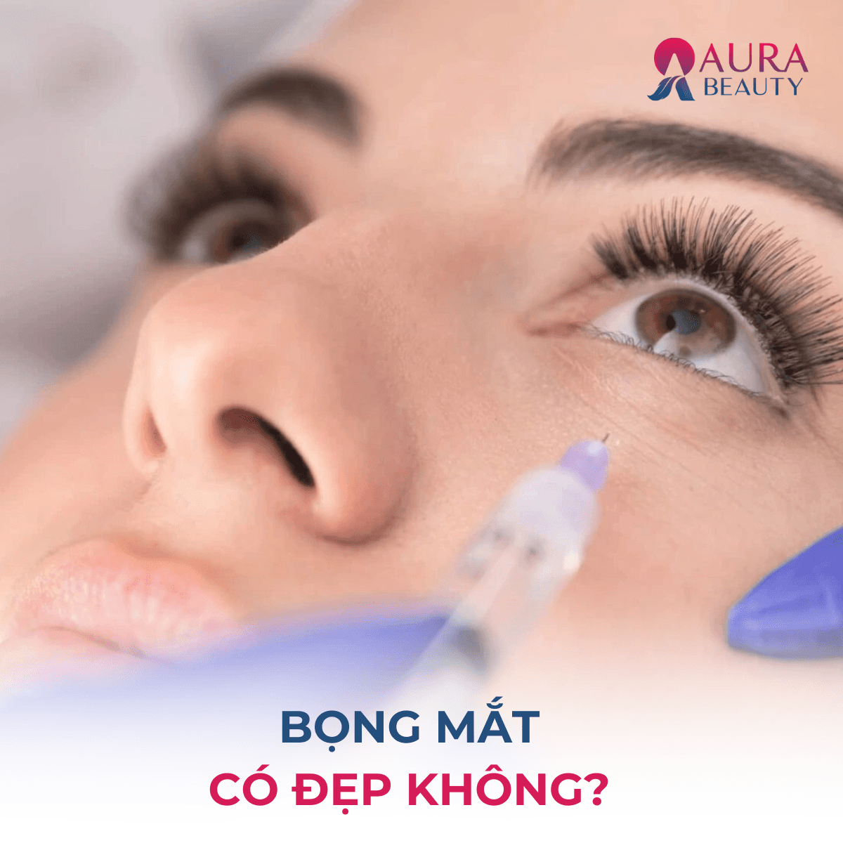 bọng mắt có đẹp không
