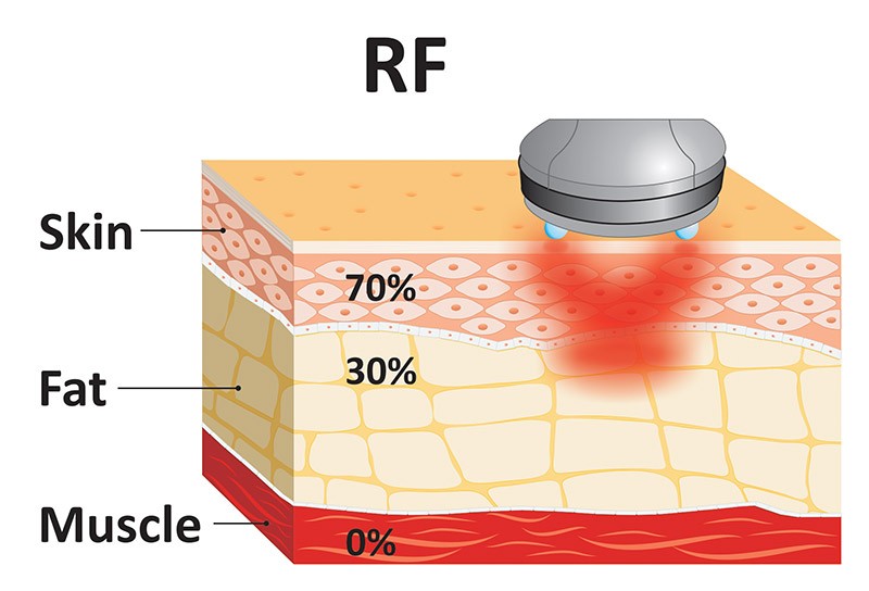 traditional RF laser lifting
