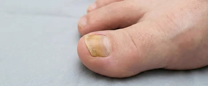 Yellow/brown, thick toenail