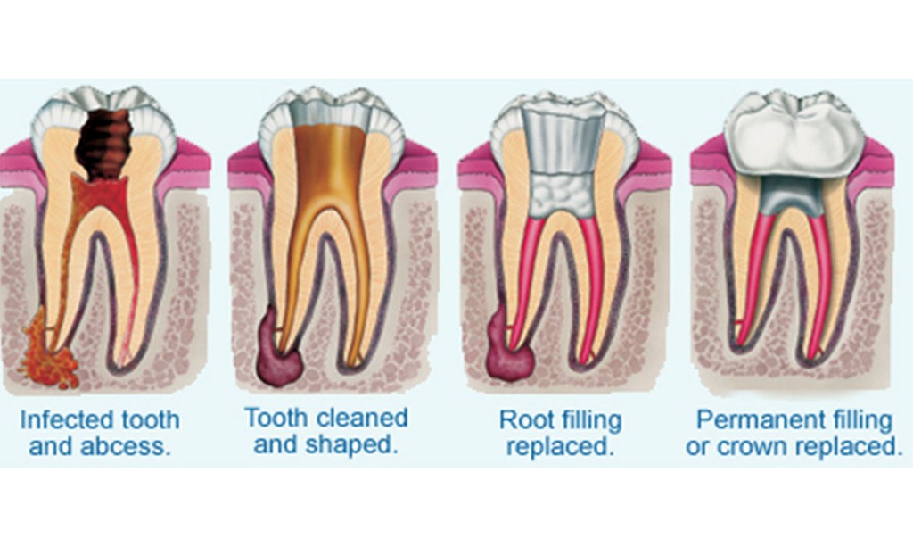 Illustration showing steps of dental crown and tooth replacement at Dentistree Kolkata.