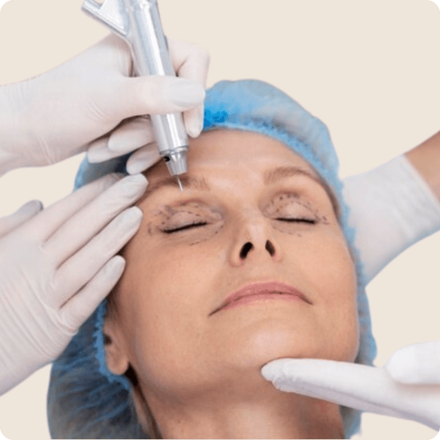 Close-up view of a person undergoing blepharoplasty, with a medical professional carefully performing the procedure on their eyelids. The individual is lying on an operating table, appearing calm and relaxed. The sterile environment emphasizes the precision of the surgery, highlighting the focus on enhancing the eyelid contour and addressing issues like excess skin or puffiness.