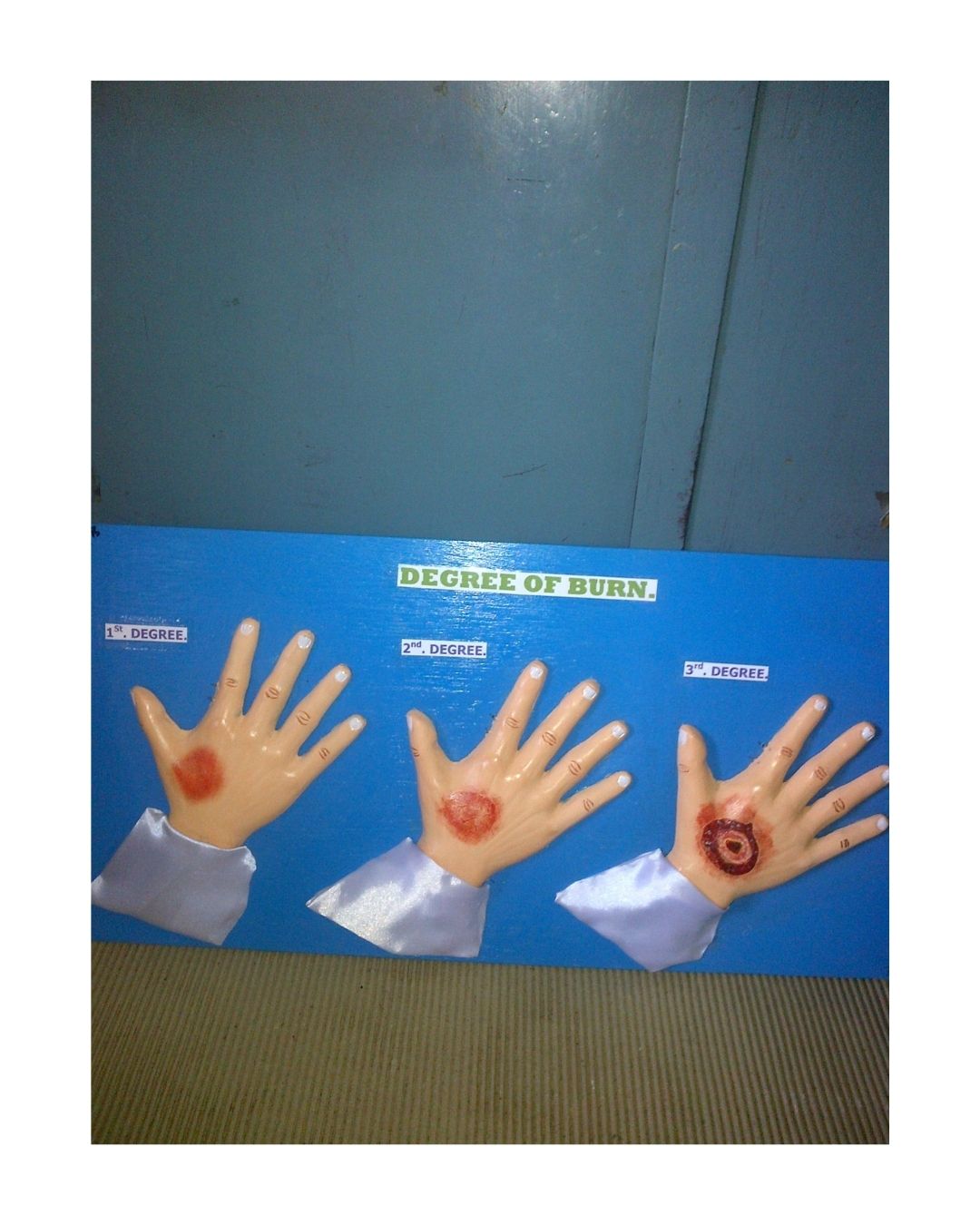 Degree of Burns (1st, 2nd, 3rd Degree)