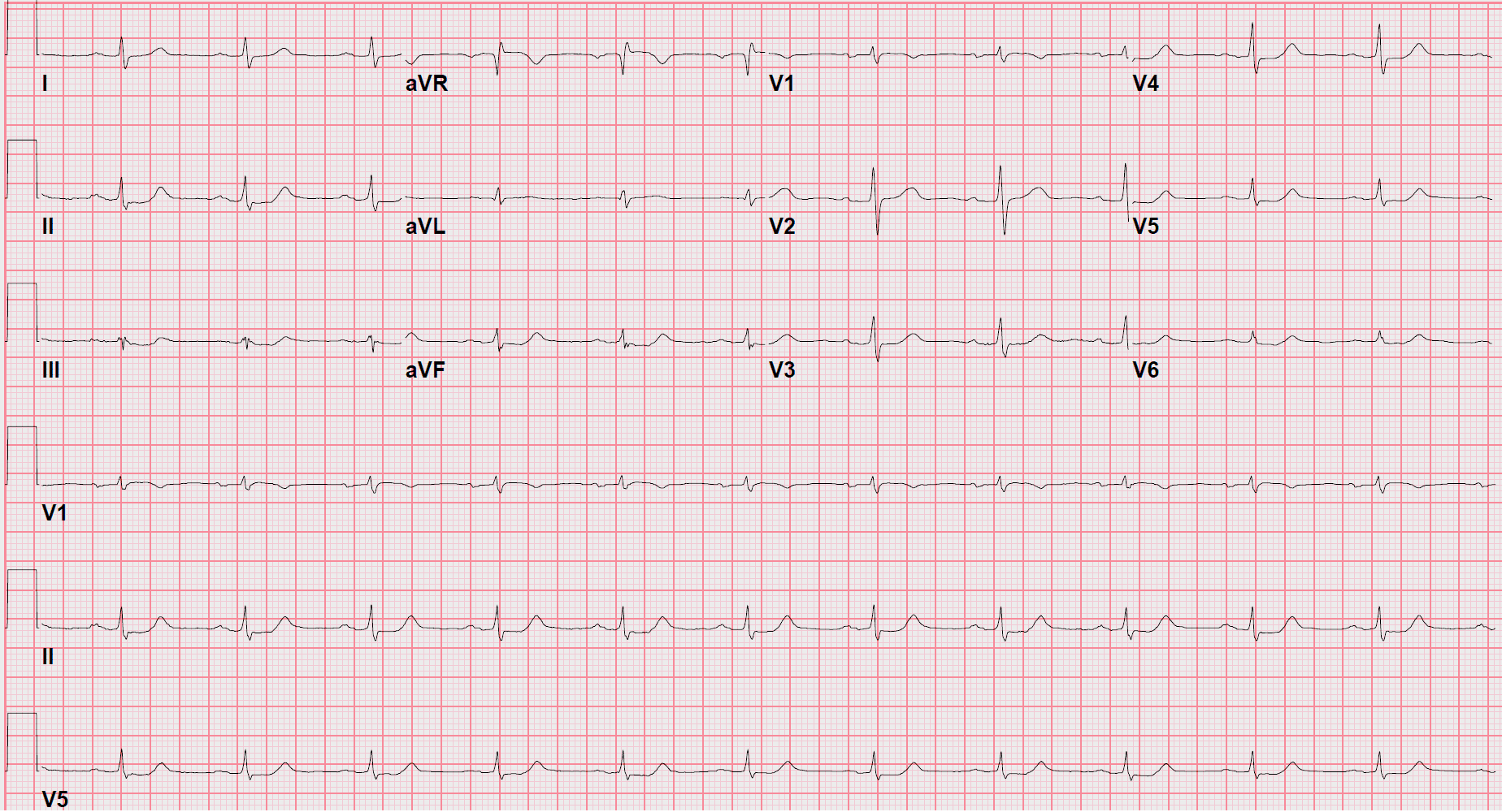 3rd ED ECG