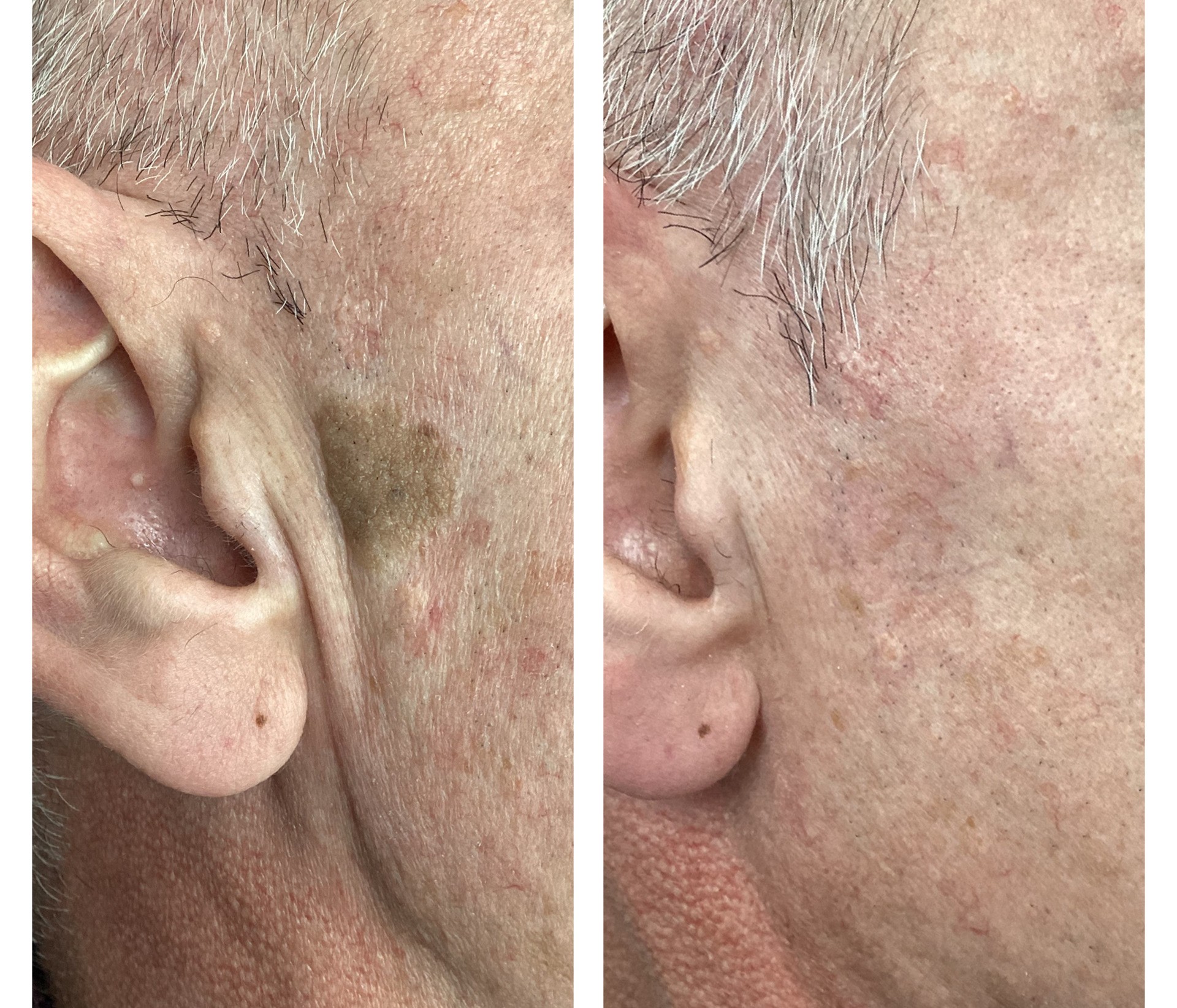 Laser treatment on woman's cheek with protective eye shield