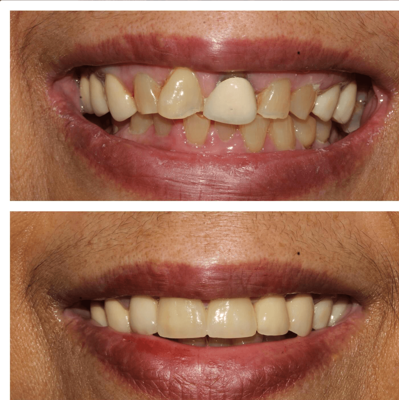 Before and After Crown Repair at ScarboroSmiles Dental Clinic in Scarborough, ON | Best dentist in Scarborough. 
