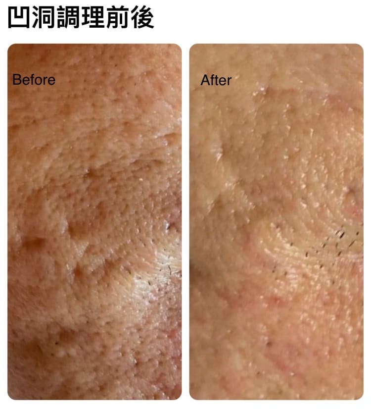 凹洞調理前後