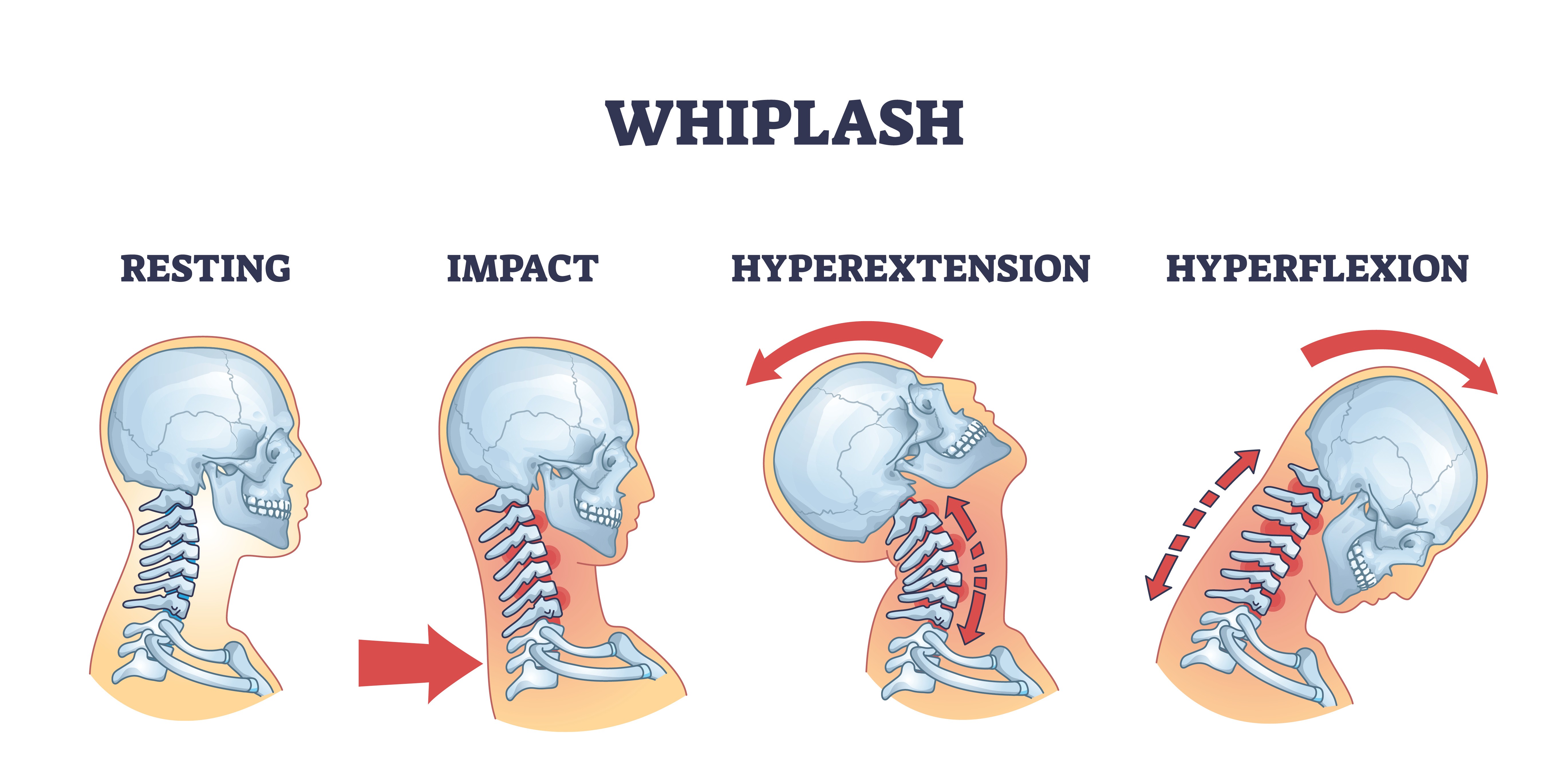 the four stages of whiplash diagram