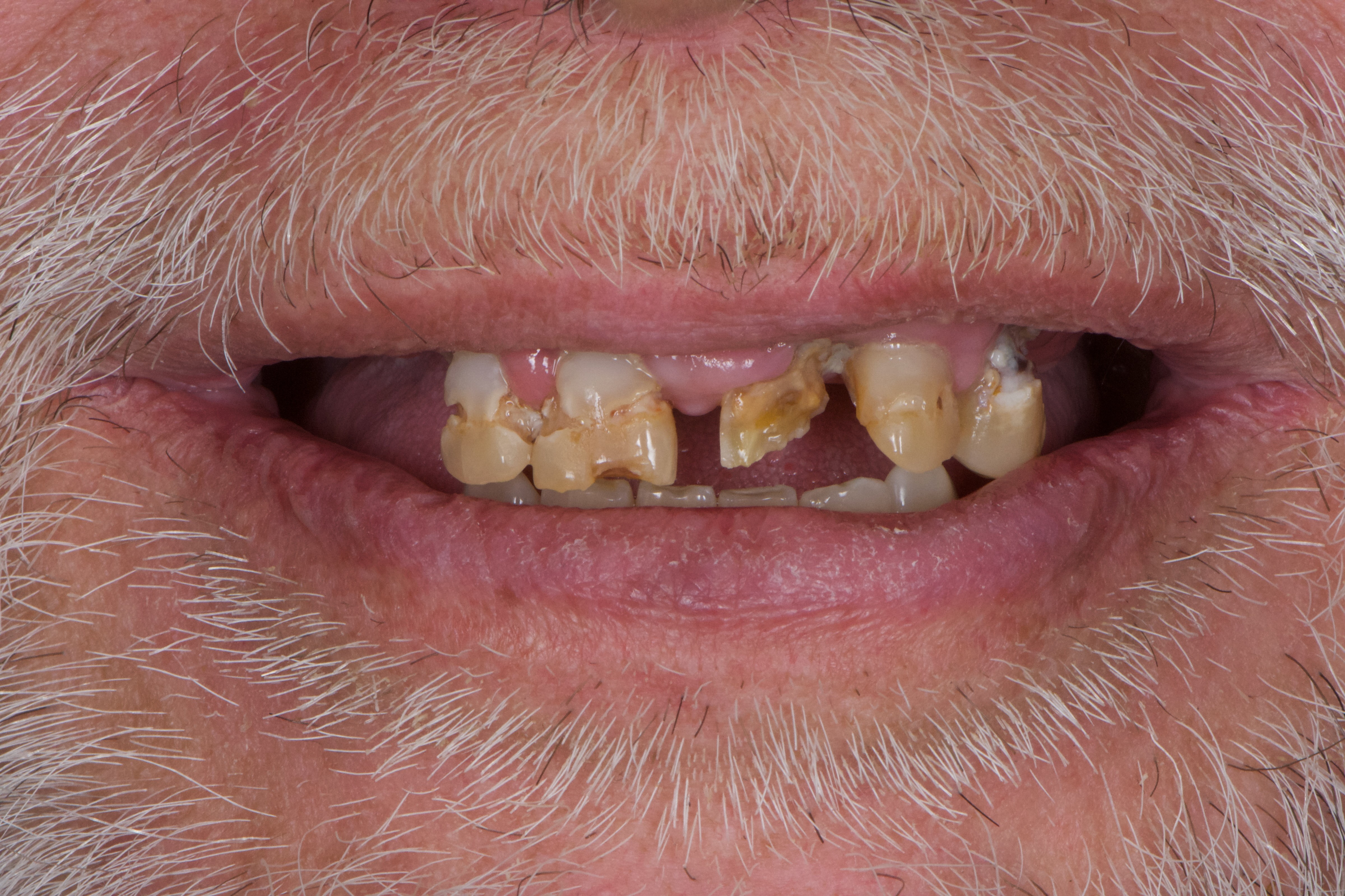 Before total mouth rehabilitation at Bloor-Yorkville Periodontics