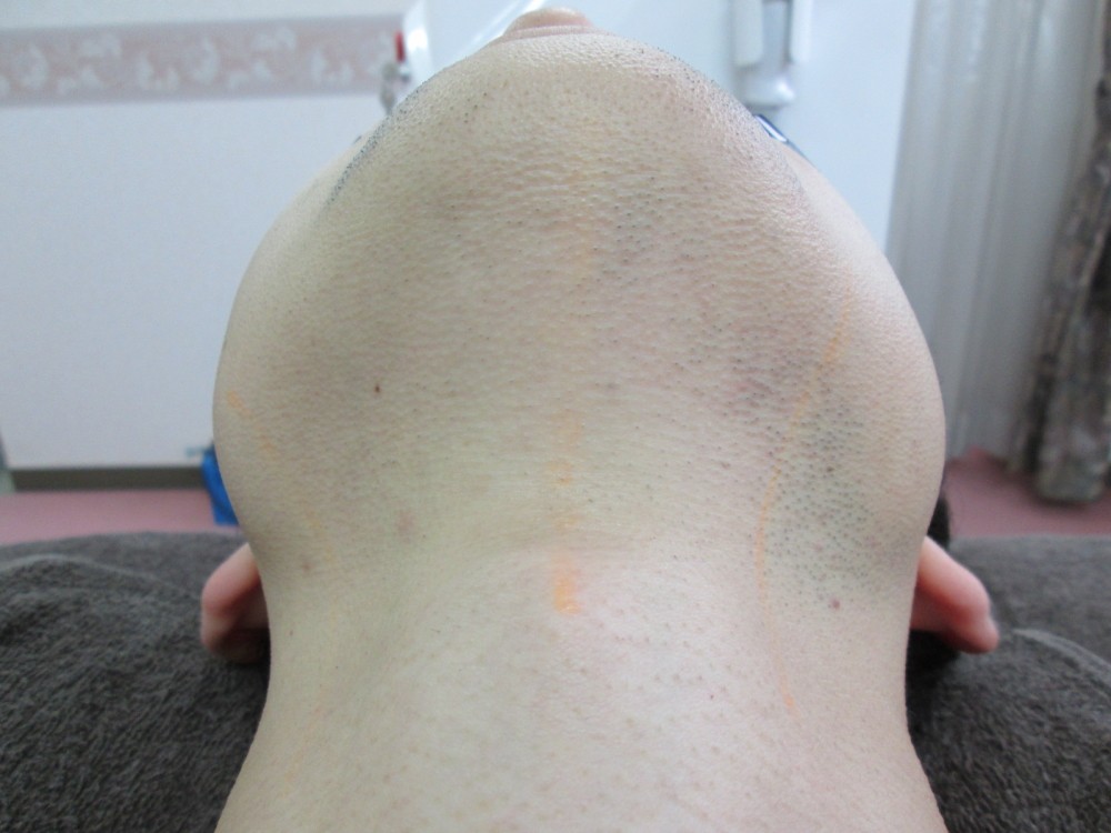 一宮市 メンズ脱毛 ヒゲ脱毛