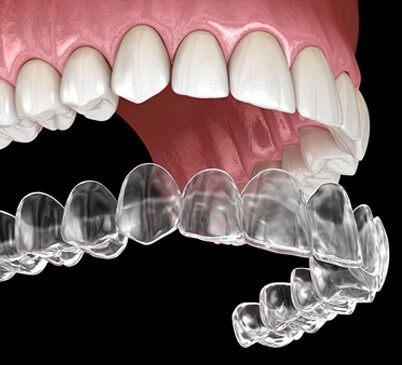 veneers