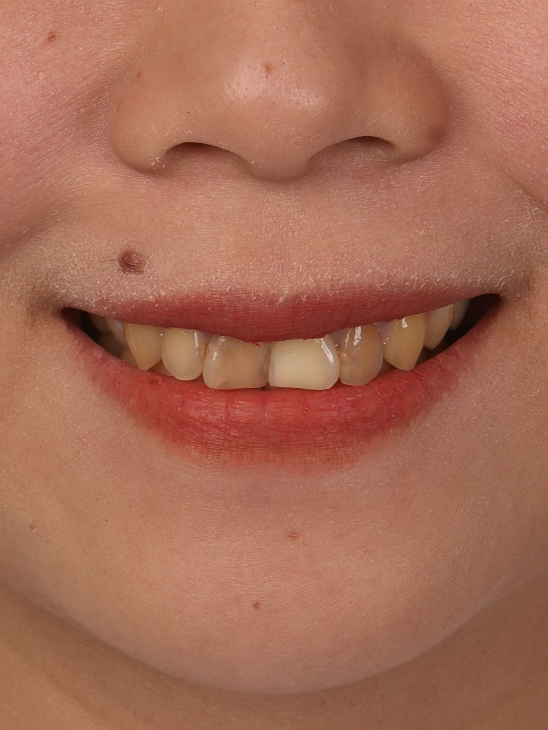 Before photo showing post endodontic tooth discoloration and uneven shade before treatment at Ora Dental Makati