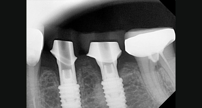커스텀 안착상태 페리사진