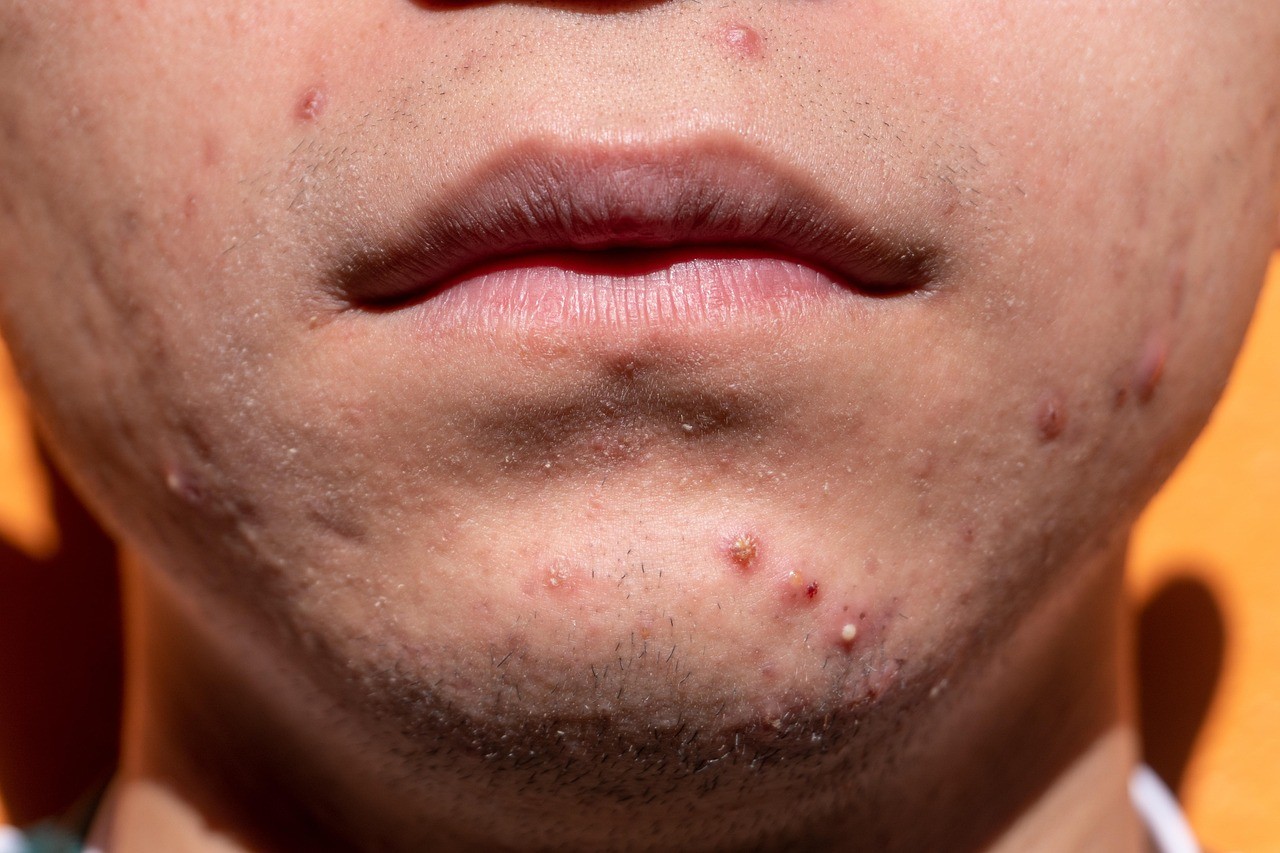acne,-shin,-dermatology,-skin,-puberty,-teen,-young,-treatment,-medicine,-sickne - yiyiphotos (pixabay)