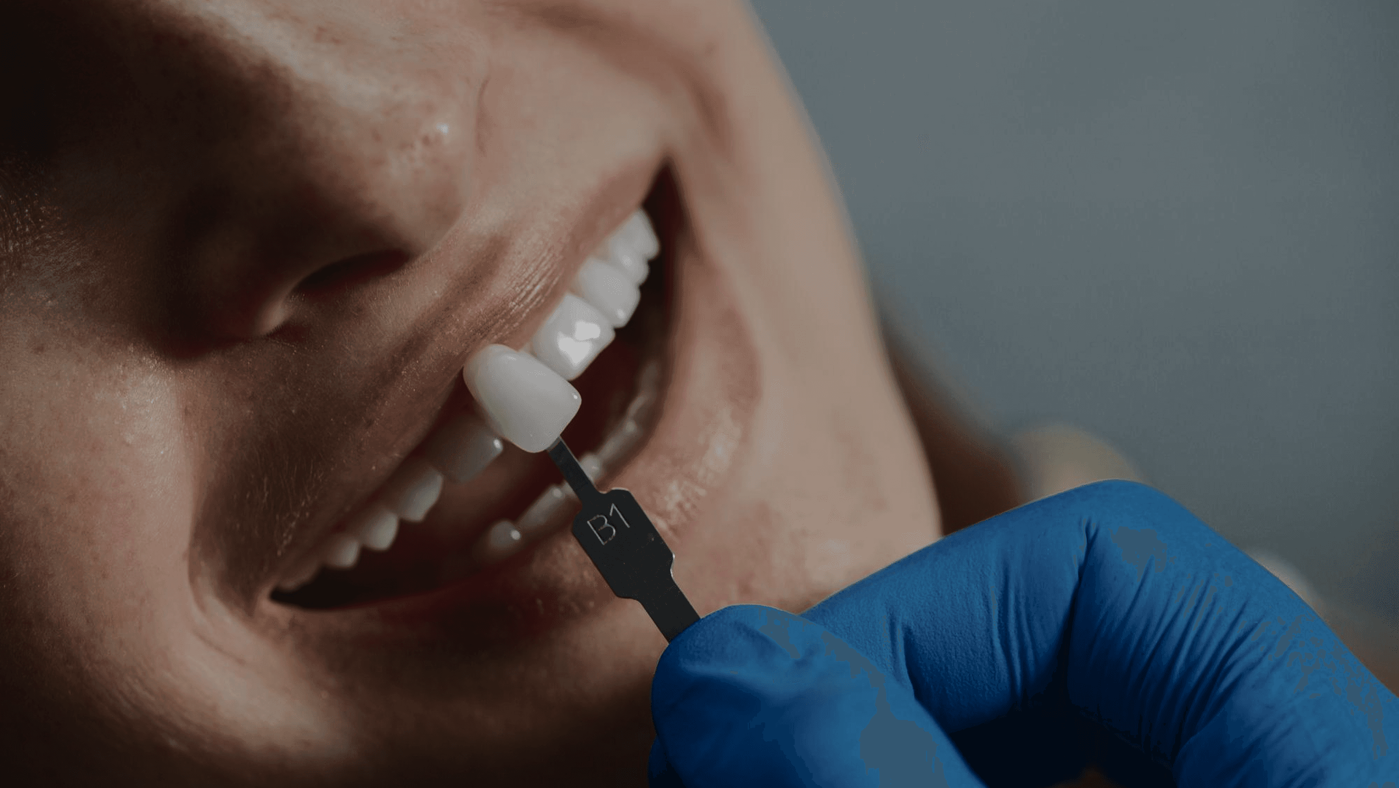 Dental Veneers & Smile Makeover