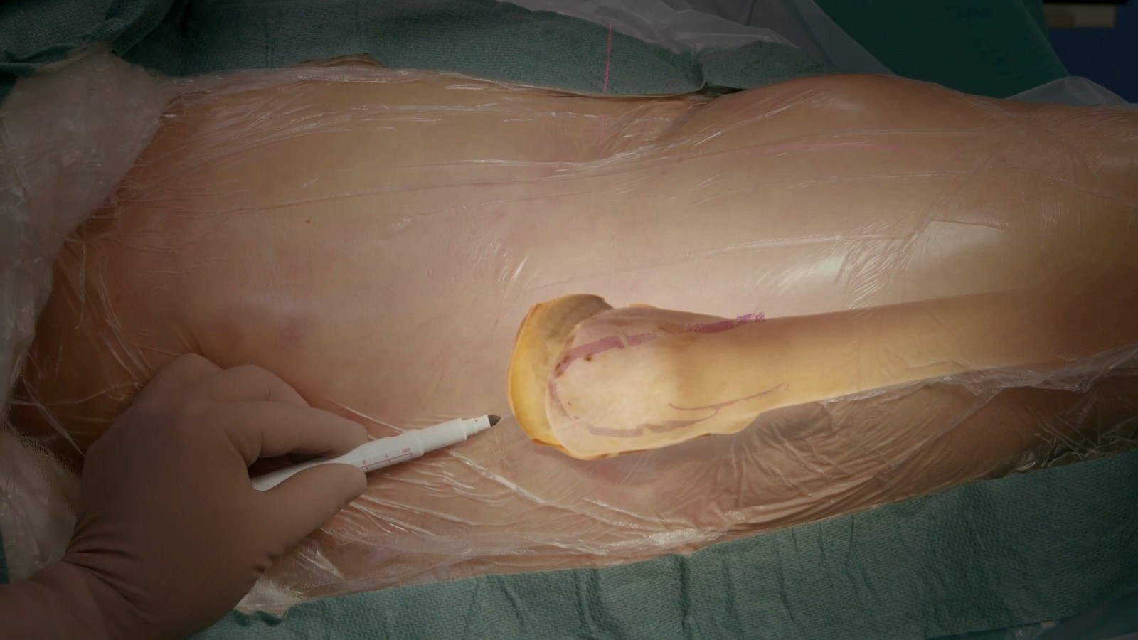 Distal biceps tendon repair
