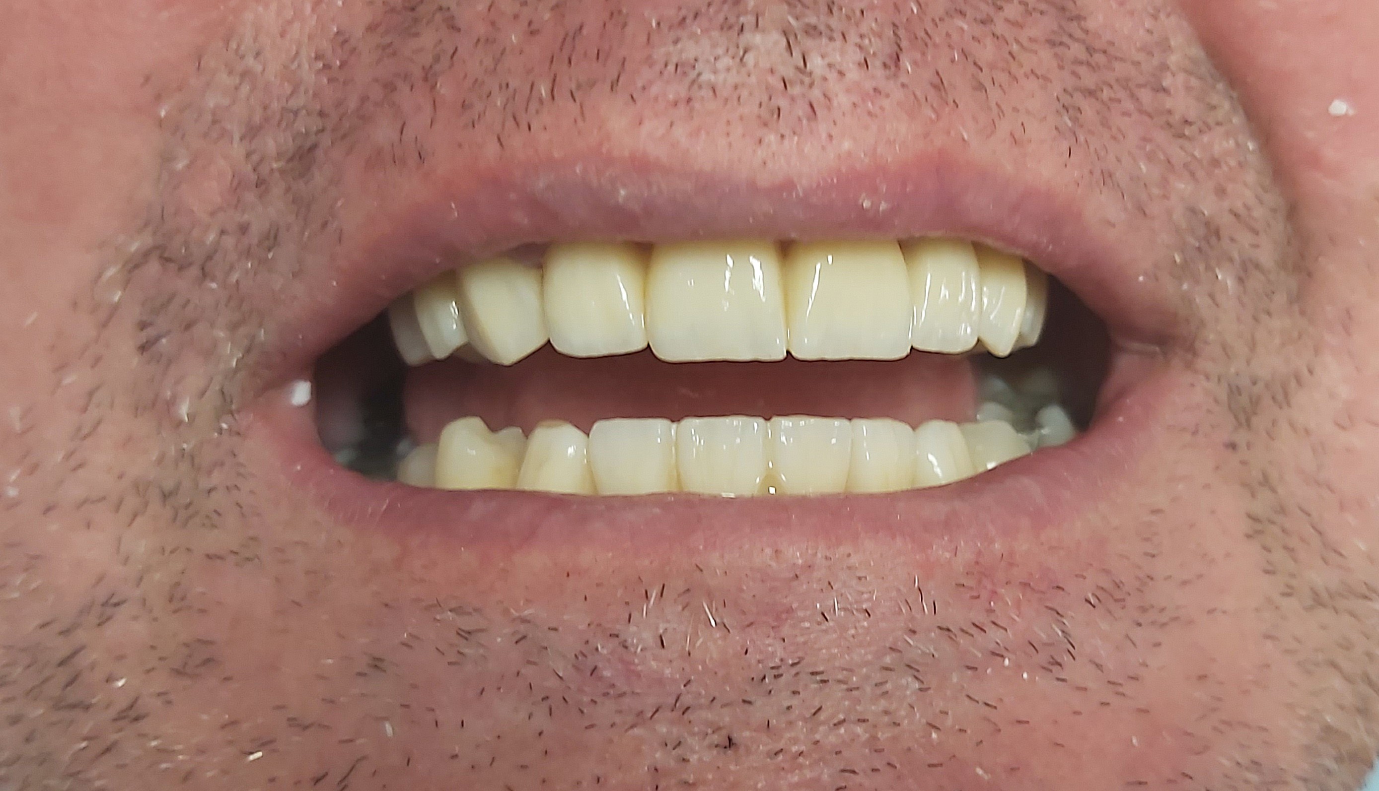 Fogászati esztétika előtte–utána – mosoly átalakítás