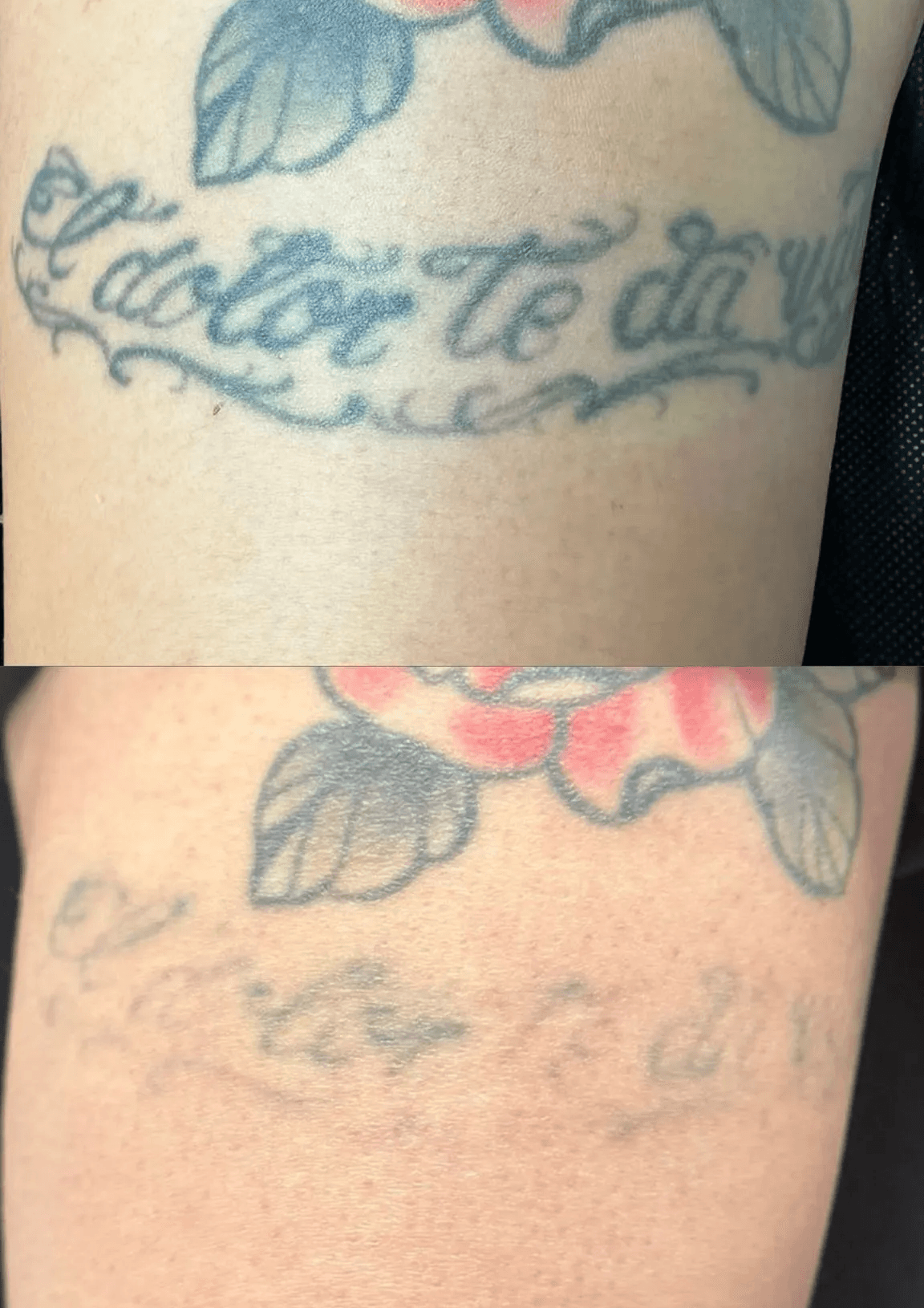 Láser para aclarar tatuaje antes de cover up en Móstoles