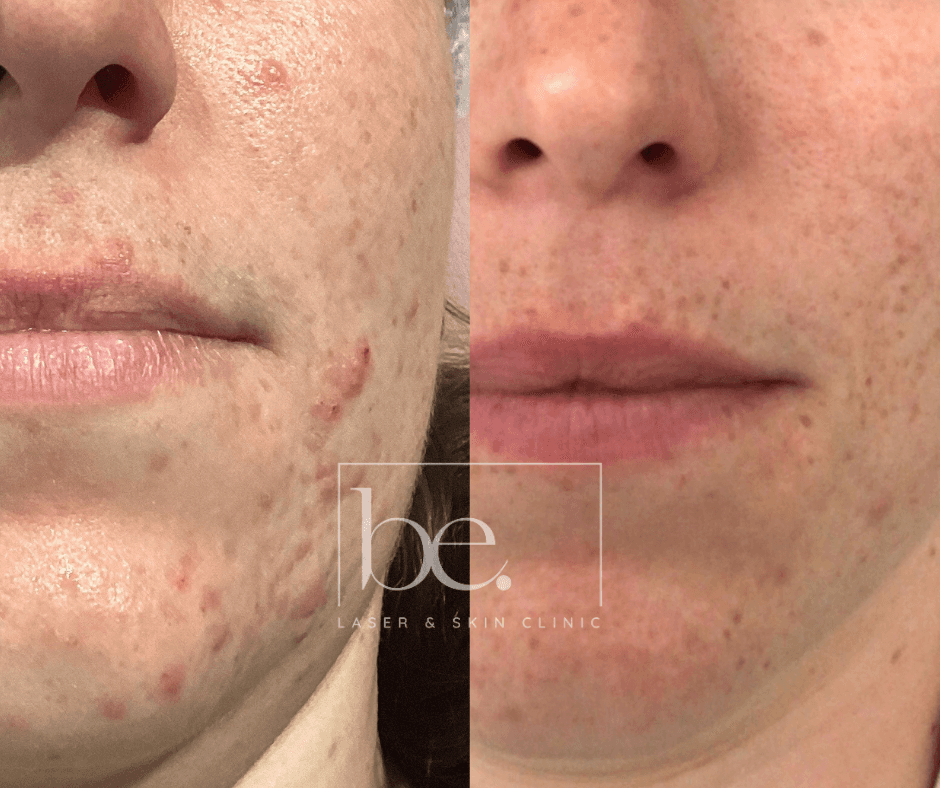 Laser treatment on woman's cheek with protective eye shield