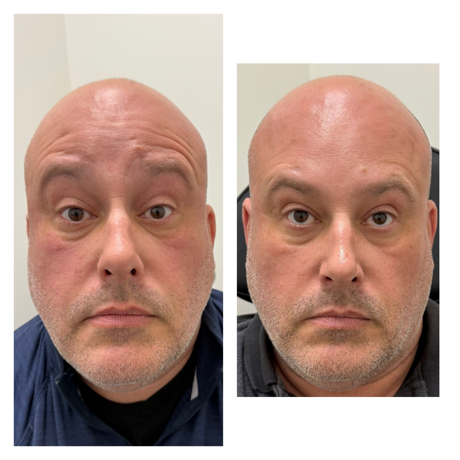 man forehead lines hagerstown md