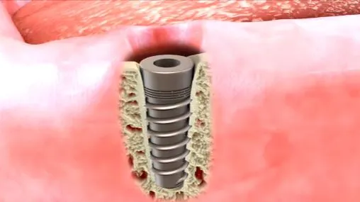 Osseointegration dental implant