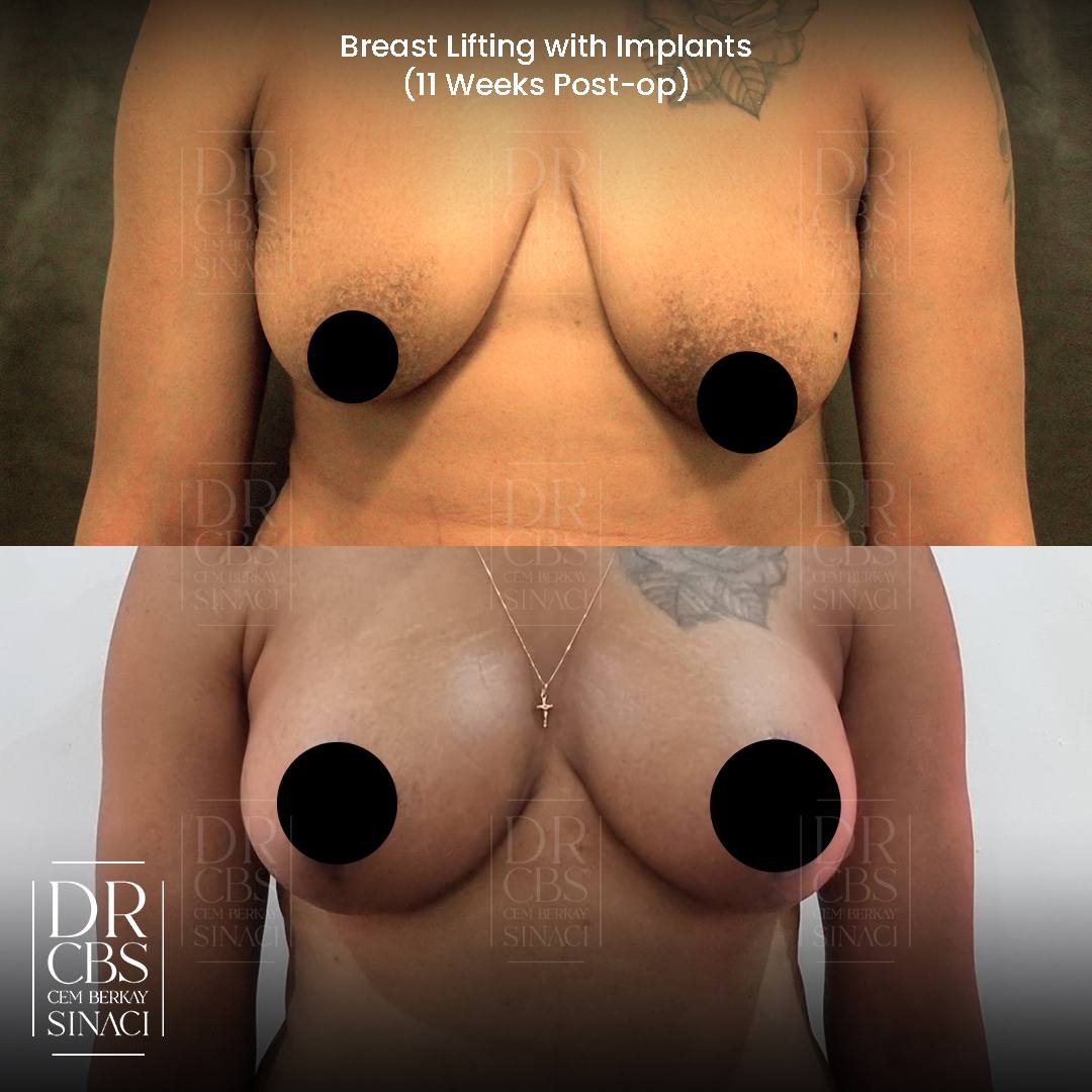 breast lift with implant mastopexy augmentation before after front view