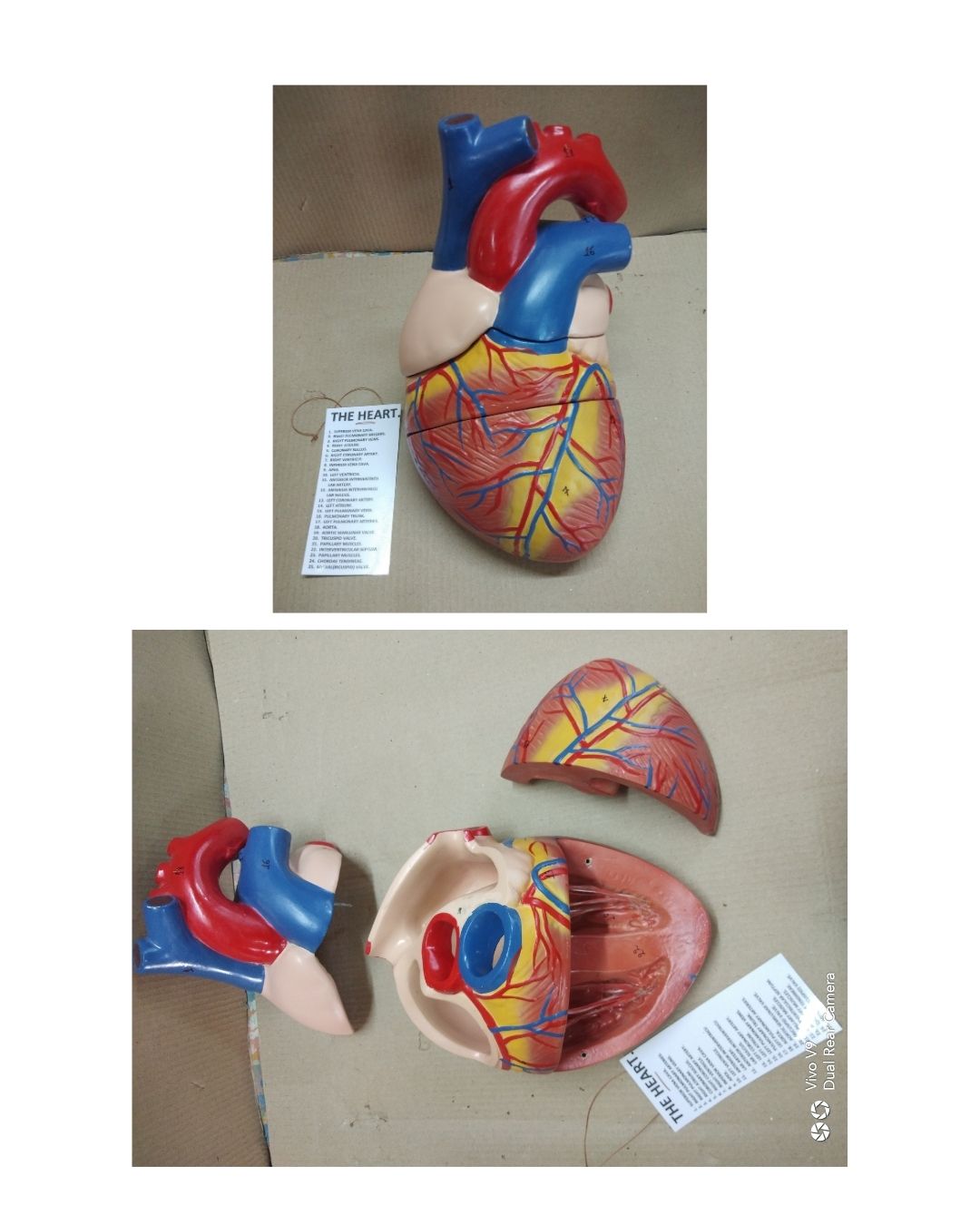 Enlarged Heart Model