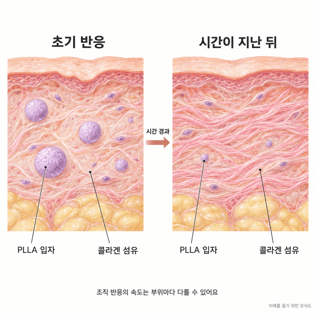 PLLA 입자 주변의 콜라겐 형성과 시간에 따른 조직 변화를 비교한 모식도