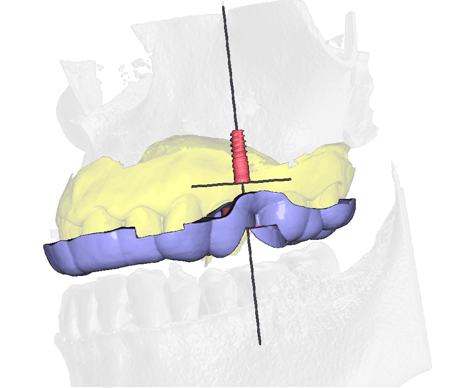 Digitálna modelácia šablóny na navigované zavedenie implantátu