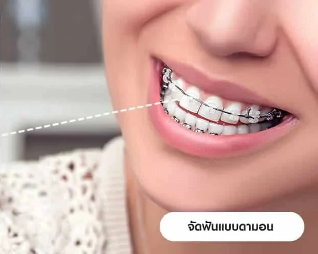 Damon braces treatment at COSDENT Smile Design
