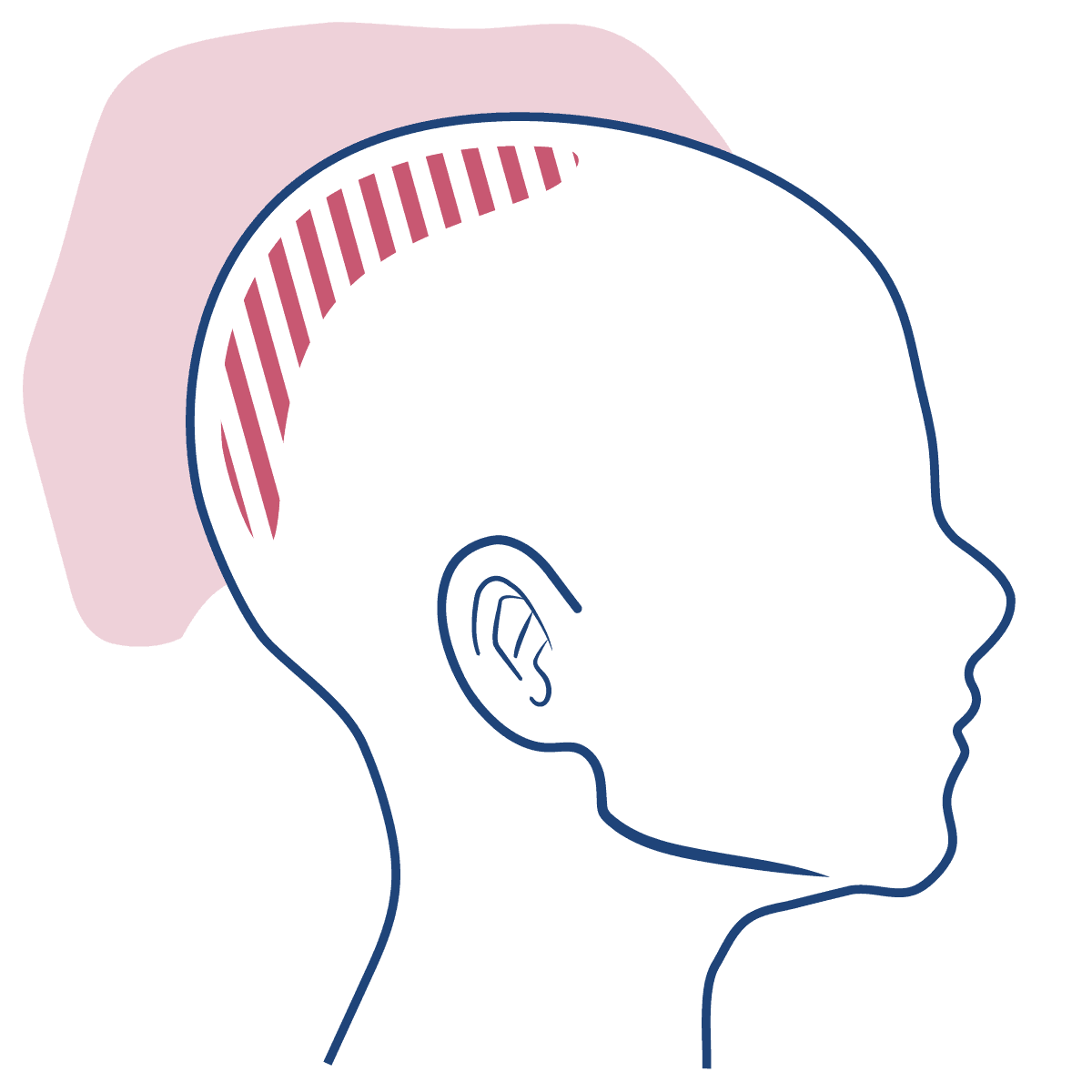 Ilustração mostra a cabeça de uma criança em perfil desenhada com linhas azuis, com uma mancha rosa escuro na parte posterior denotando o inchaço da cabeça, característico da hidrocefalia