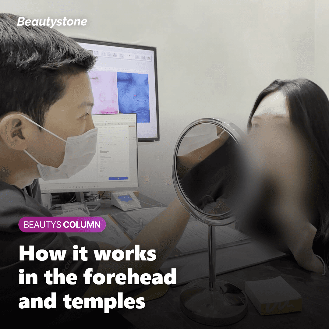 Illustration of how Juvelook Volume works in the forehead and temples