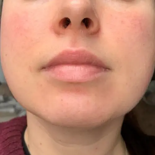 After LED light therapy at The Vancouver Aesthetician — redness and inflammation visibly reduced and skin calmed