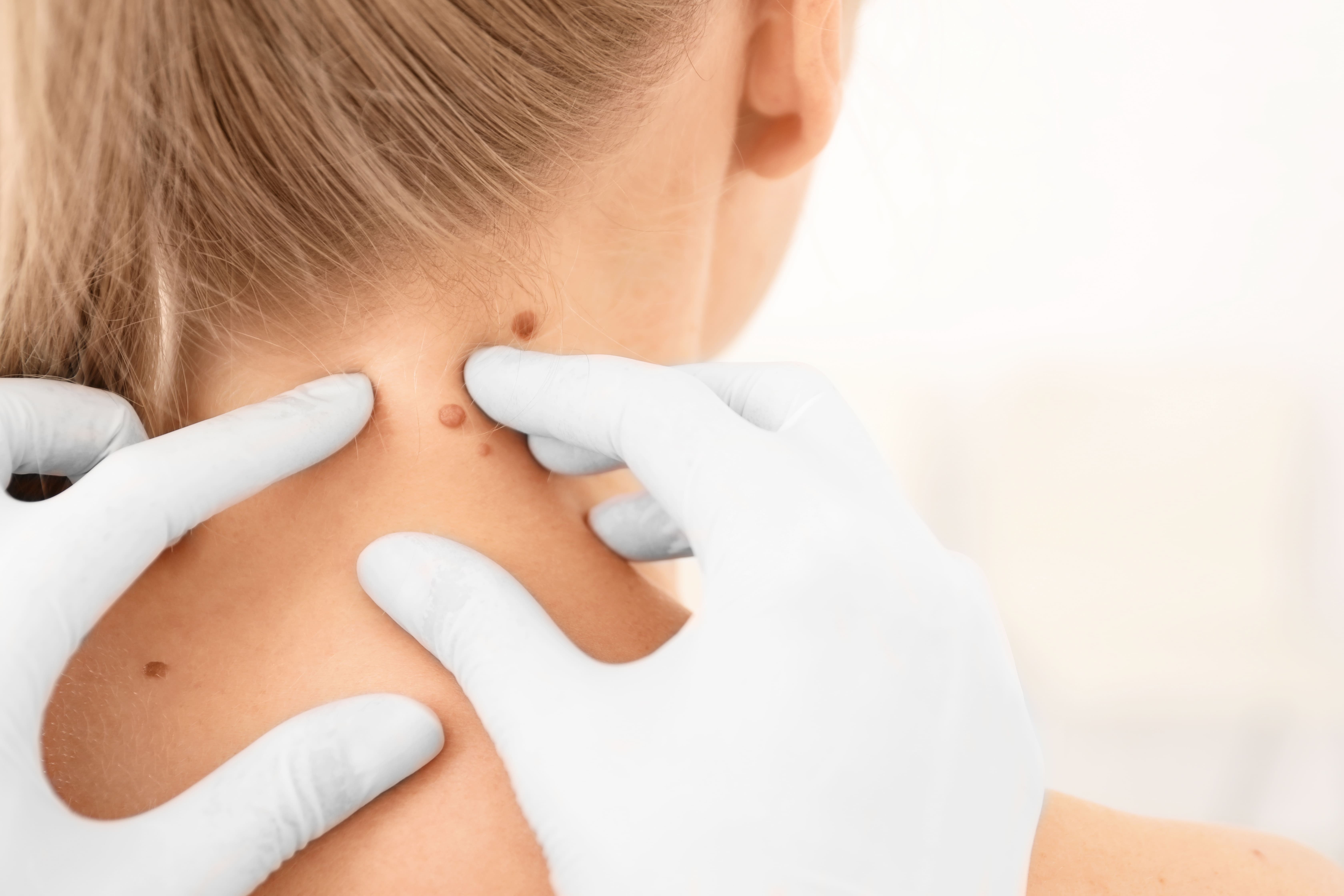 Muttermal Check in Rheinbach und Mechernich - Dermatologie Hautzentrum Rheinbach