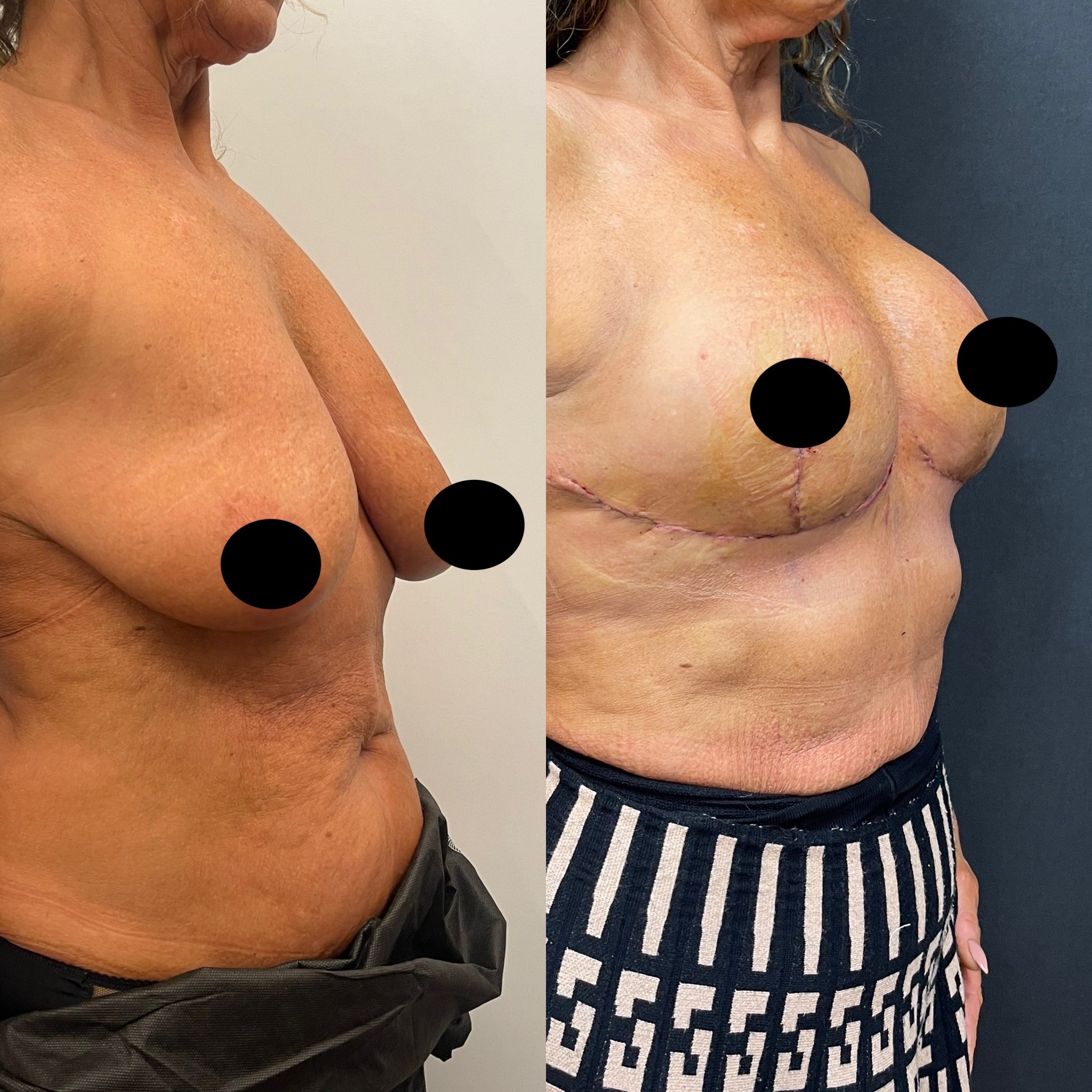 breast lift before after 3 days post-op right oblique view