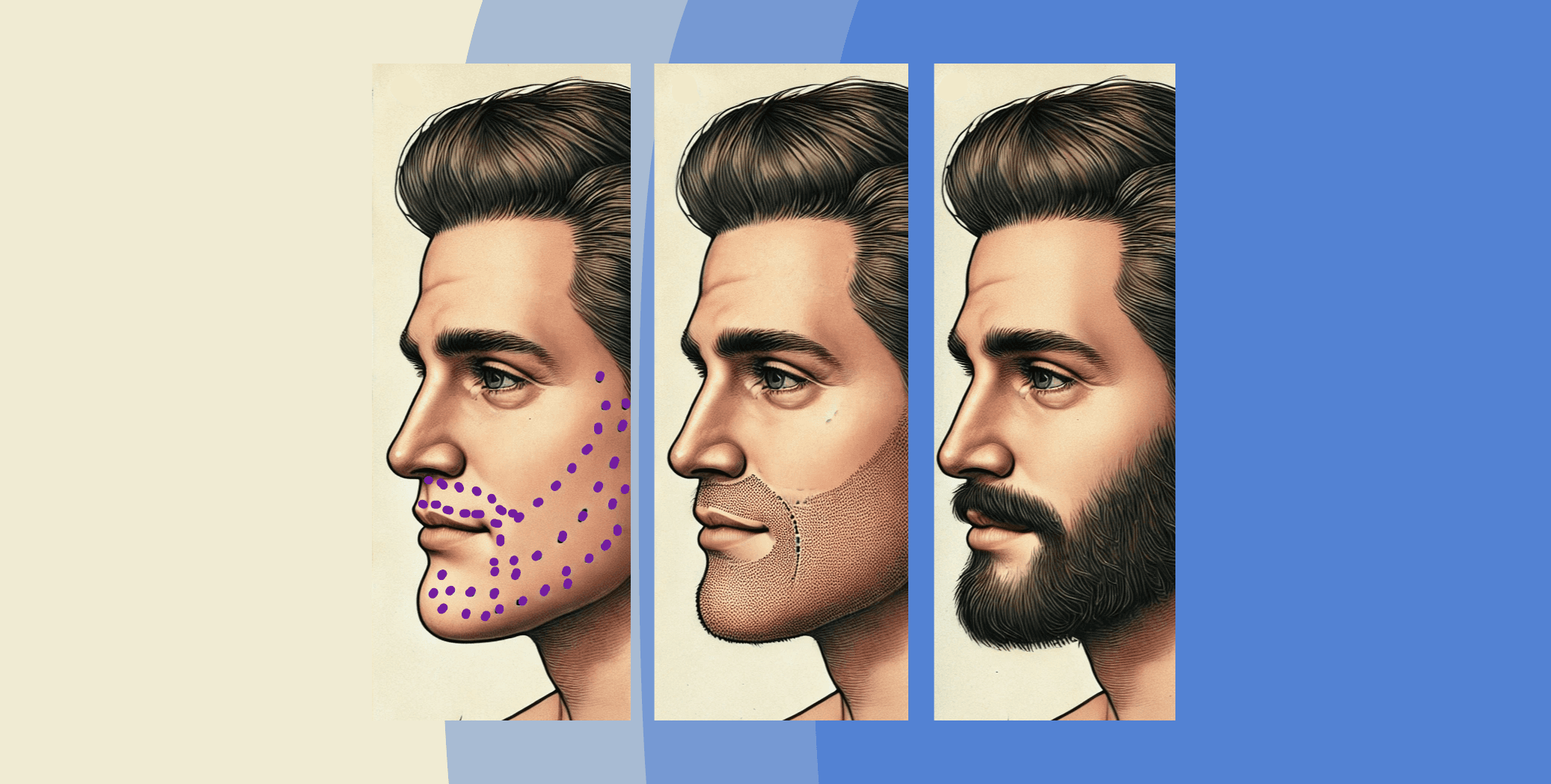 3 images side to side of a man first getting his beard transplant markuings, then a week after, then 6 months after. 