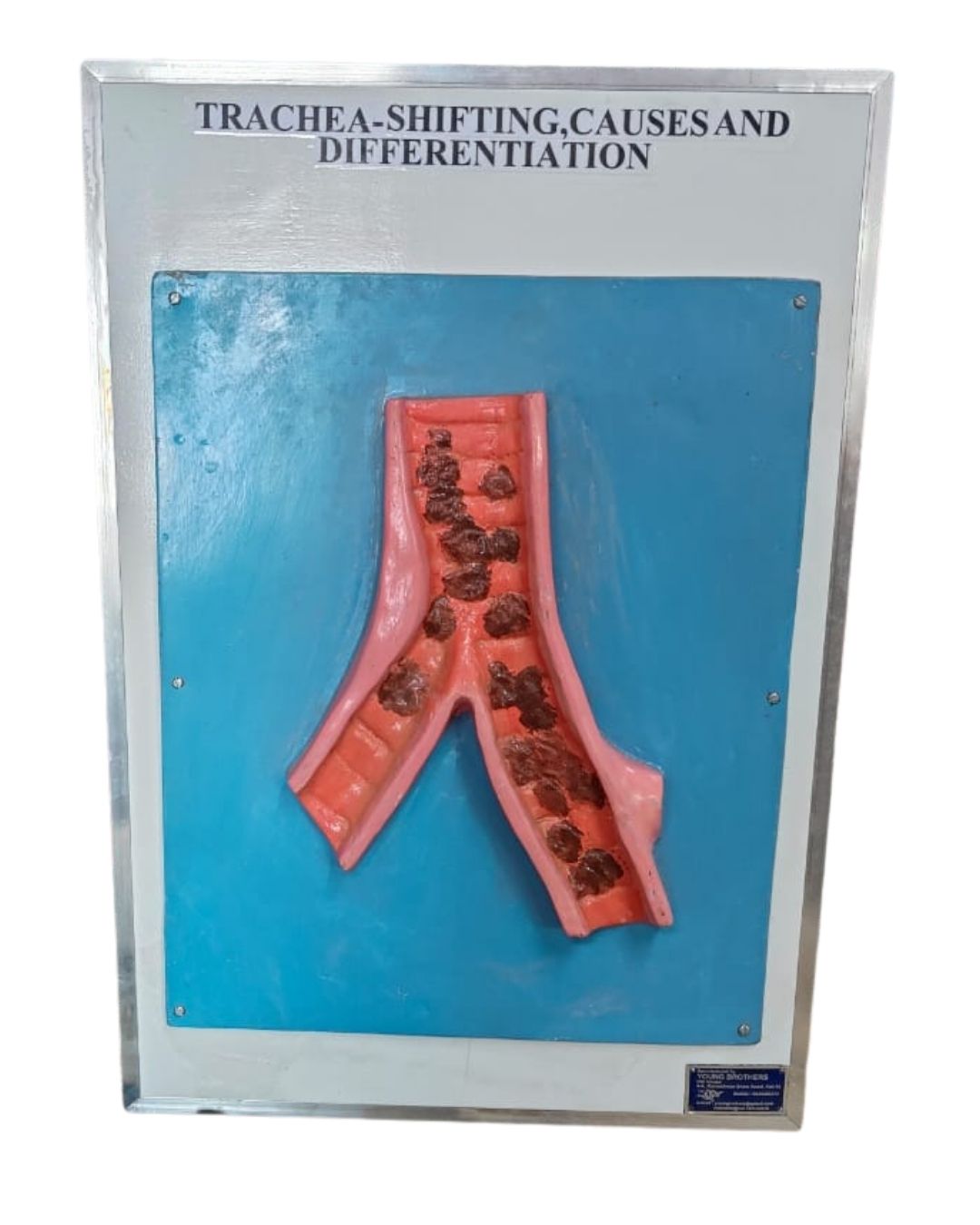 Trachea – Shifting, Causes & Differentiation