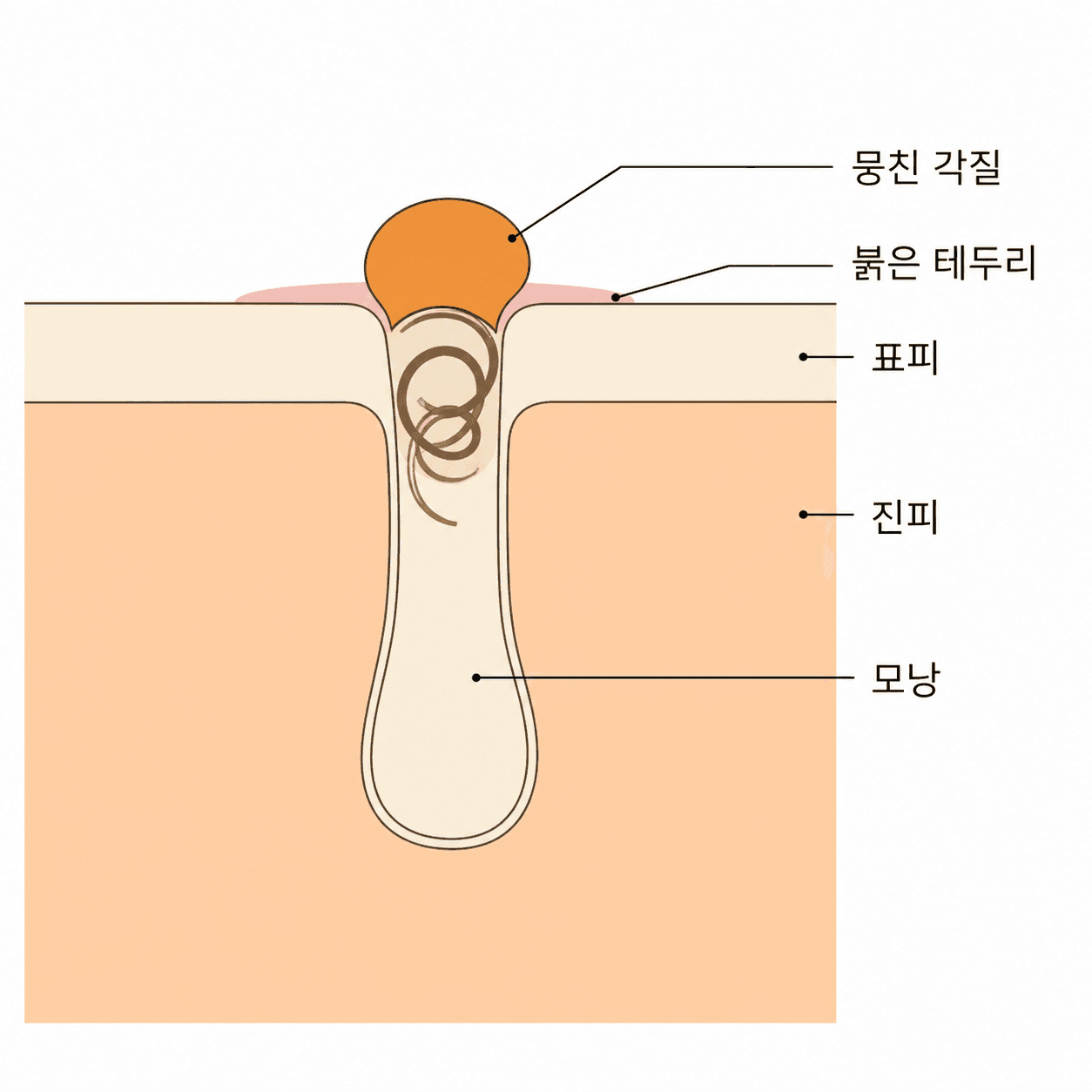 마개는 표면이 아니라 모낭 입구 안쪽에 자리 잡고 있어요.